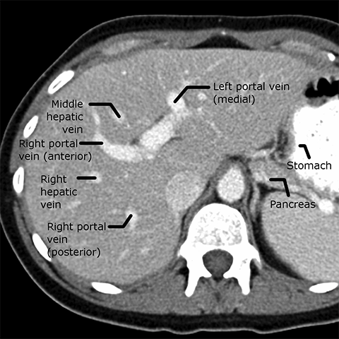 liver ct radiology